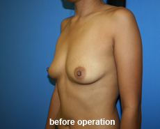 plastic-surgery-breast-augmentation